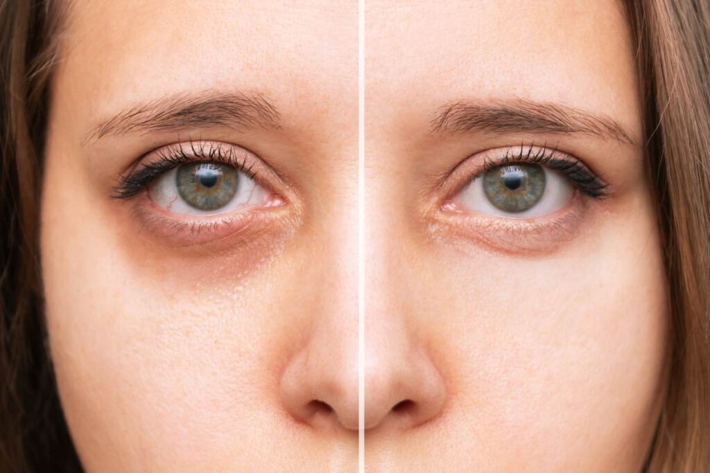 Natural Remedies for Under Eye Bags