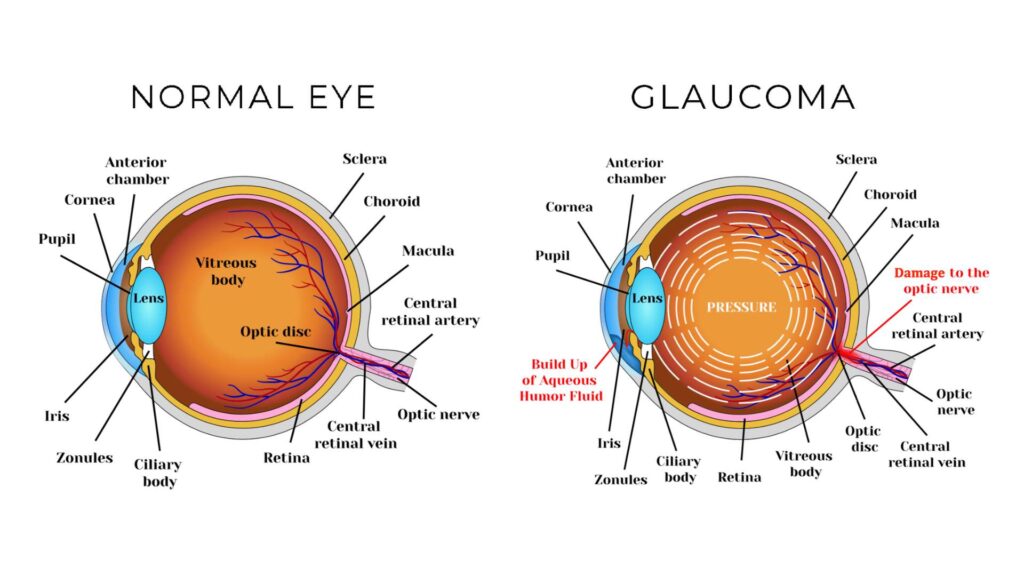 Normal eye vs Glaucoma