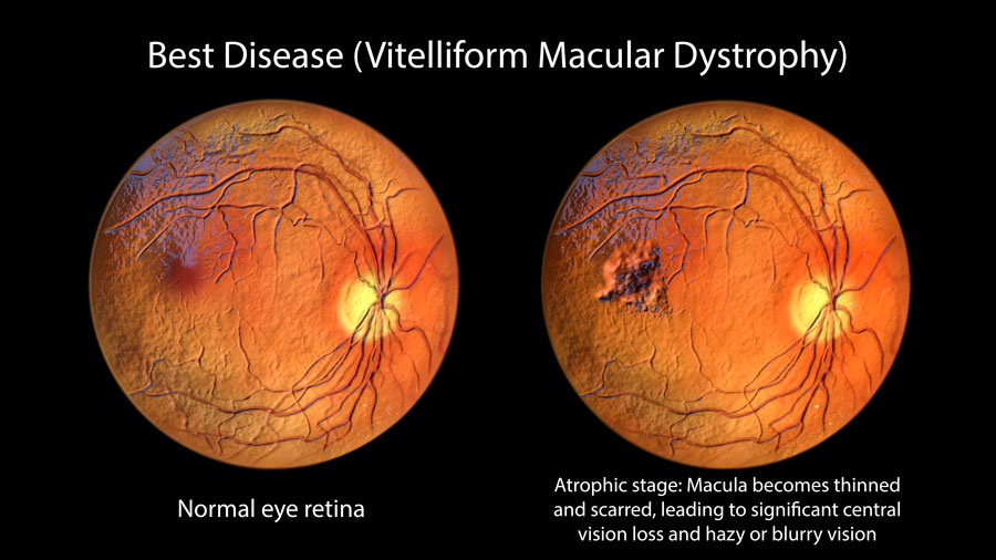 Best's Disease (Macular Dystrophy)