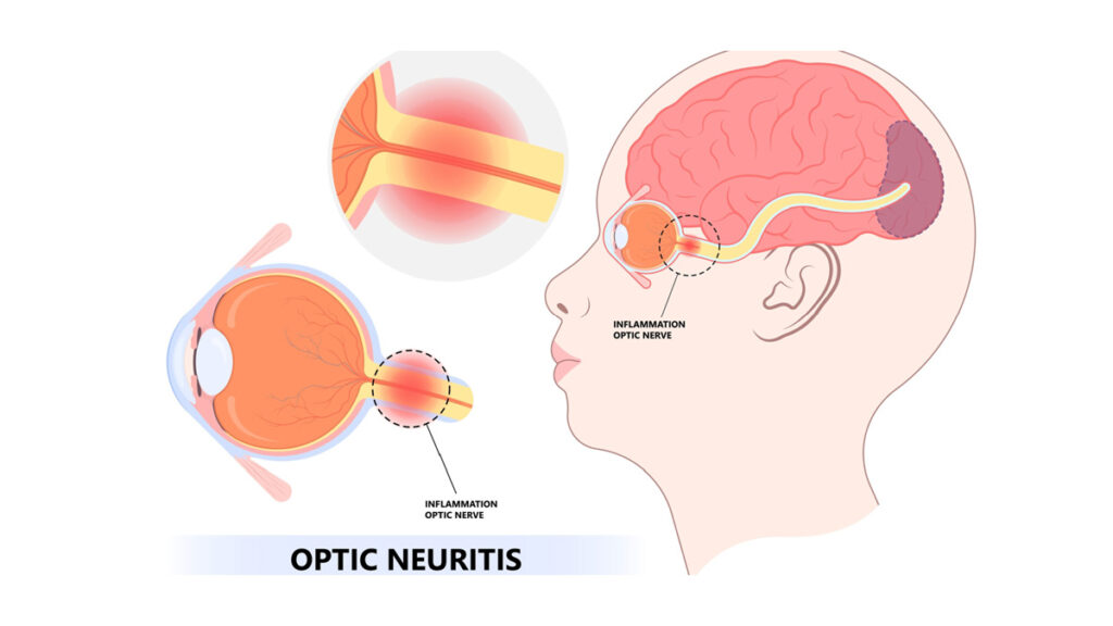 Dr-Andy-Rosenfarb-Optic-Neuritis