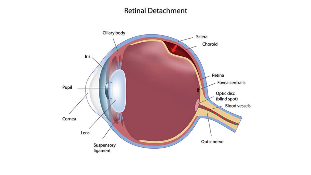 Dr-Andy-Rosenfarb-Retinal-Detachment