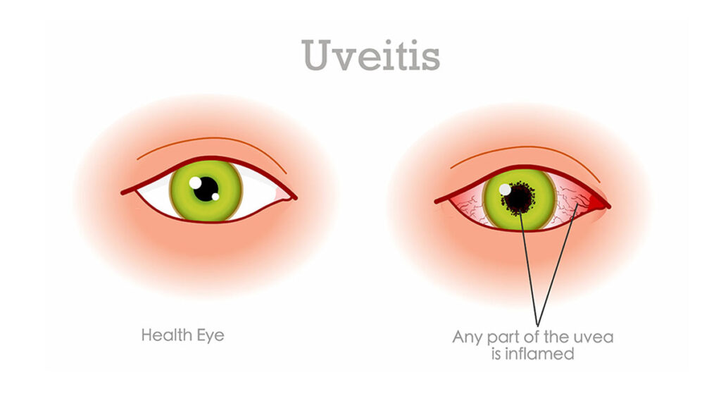 Dr-Andy-Rosenfarb-Uveitis