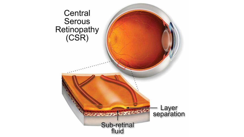 Central Serous Choroidopathy