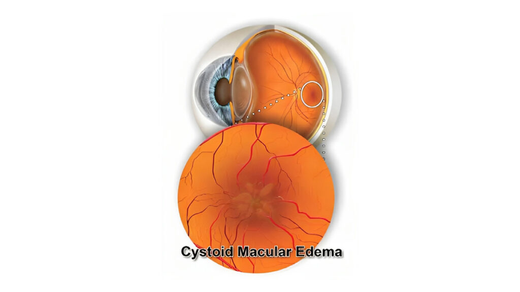 Dr.-Andy-Rosenfarb-Cystoid-Macular-Edema