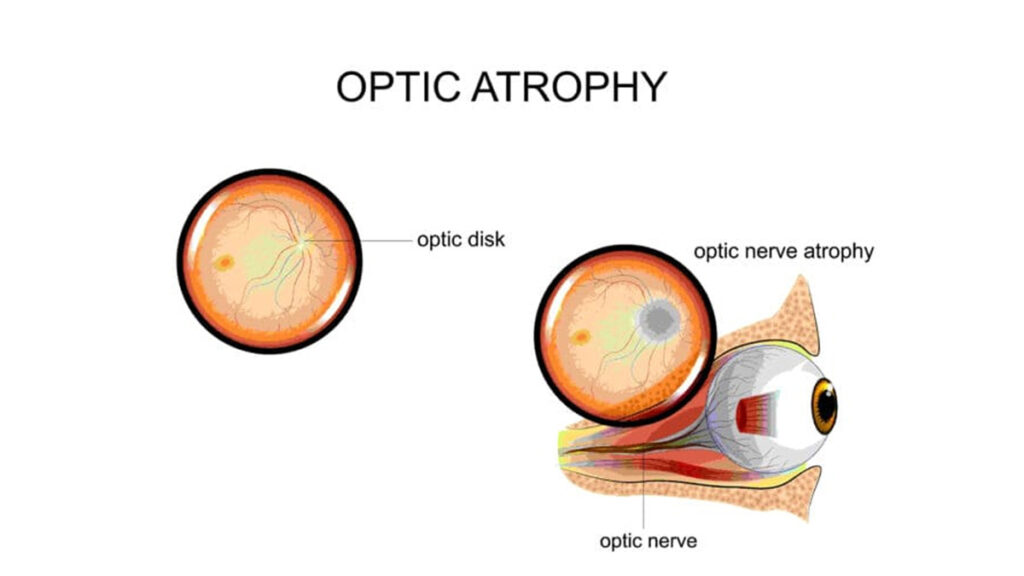 Dr.-Andy-Rosenfarb---Optic-Nerve-Atrophy