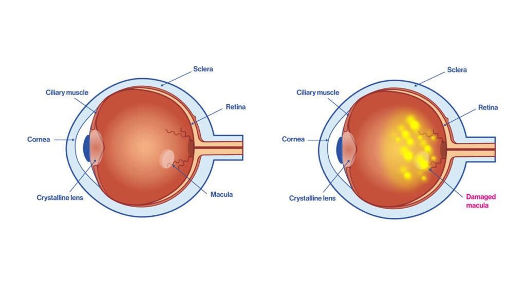 Macular Degeneration (AMD)