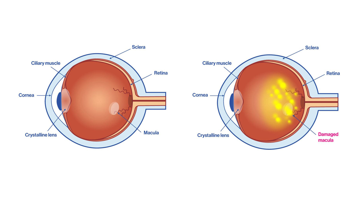 Macular Degeneration (AMD) - AcuVision Acupuncture!